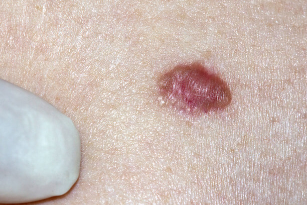 Basal Cell Carcinoma