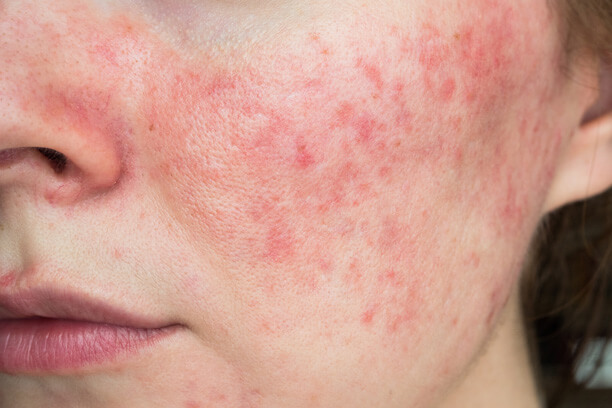 ROSACEA